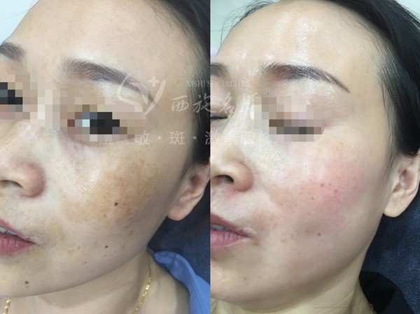 真的能行！不提取，不剝脫，涂抹就下“斑”