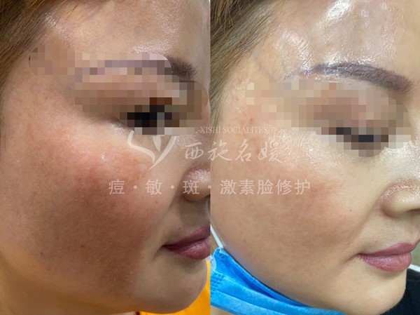 真的能行！不提取，不剝脫，涂抹就下“斑”