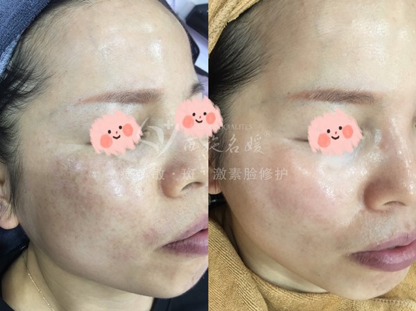 真的能行！不提取，不剝脫，涂抹就下“斑”
